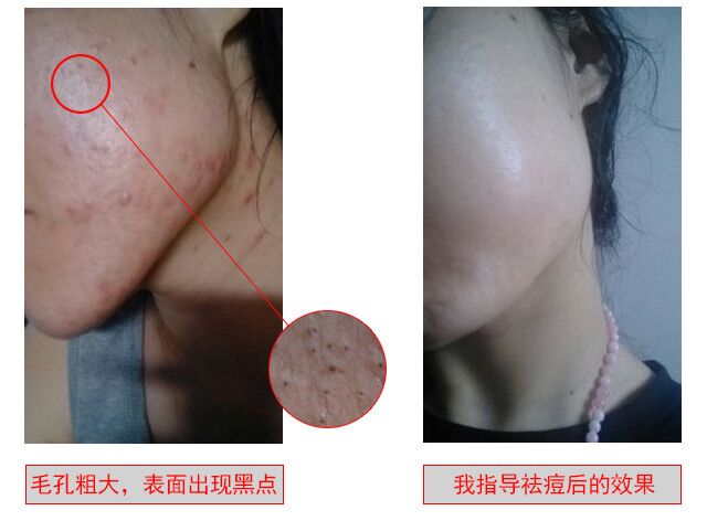 祛除痘印最有效的祛痘神器,祛痘神奇小妙招
