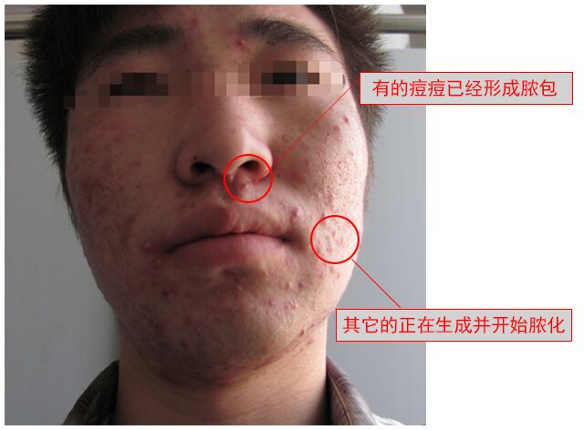 祛除痘印最有效的祛痘神器,祛痘神奇小妙招