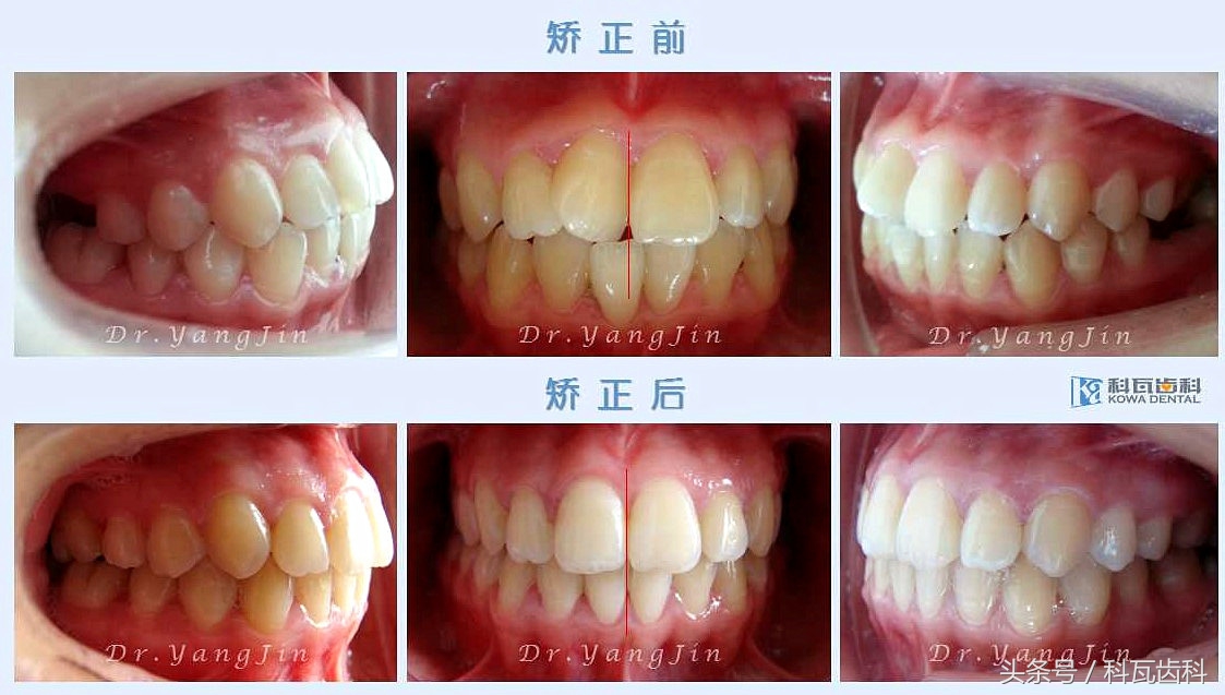 青少年适合种植牙还是假牙,缺牙活动假牙修复