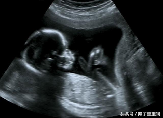 怀孕八个月忽然早产，胎儿“伸手”求救被拒，医生怒斥婆婆太狠心