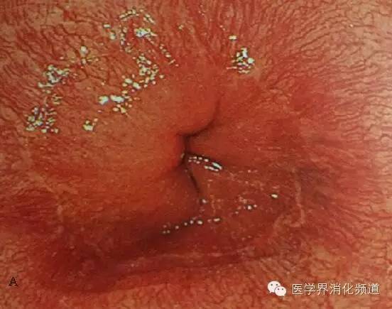 barrett食管的症状是什么,barrett食管症状可怕吗