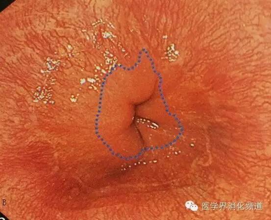 barrett食管的症状是什么,barrett食管症状可怕吗