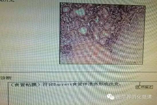 barrett食管的症状是什么,barrett食管症状可怕吗