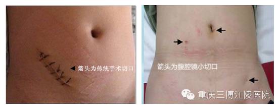 宝宝疝气手术疤痕,成人疝气修补手术疤痕