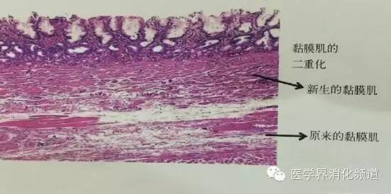 barrett食管的症状是什么,barrett食管症状可怕吗