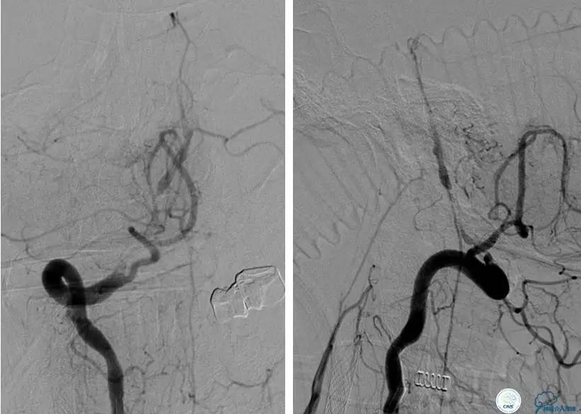 颅内动脉狭窄介入治疗研究,颅内血管cta副作用