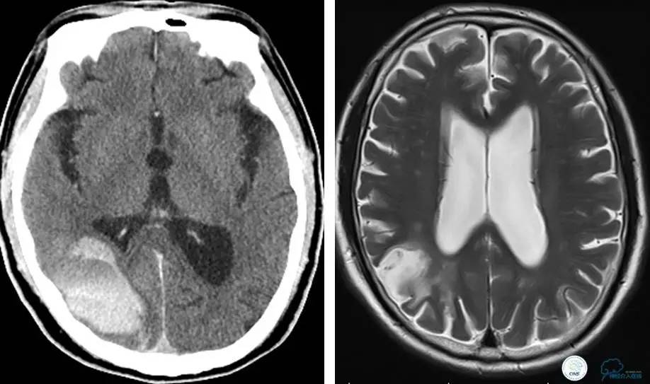 颅内动脉狭窄介入治疗研究,颅内血管cta副作用