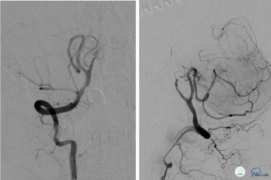 颅内动脉狭窄介入治疗研究,颅内血管cta副作用