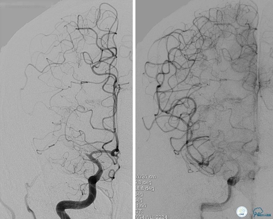 颅内动脉狭窄介入治疗研究,颅内血管cta副作用