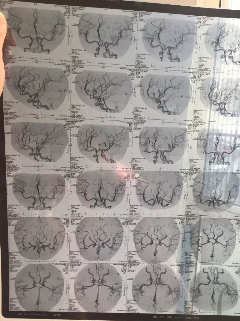 脑动静脉畸形引起的癫痫怎么治疗,脑动静脉畸形介入栓塞治愈率