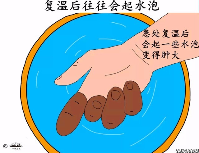 登山晒伤了怎么办,登山8000米冻伤手指