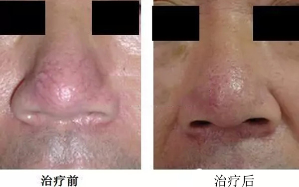 怎样分辨酒渣鼻,酒渣鼻严重怎么治疗