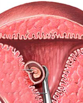 人流和药物流产哪个危害小,怀孕15天药物流产危害