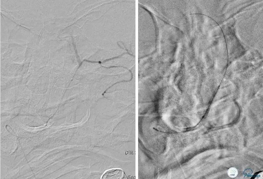 颅内动脉狭窄介入治疗研究,颅内血管cta副作用
