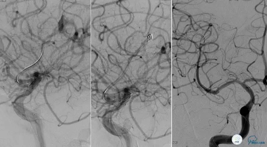 颅内动脉狭窄介入治疗研究,颅内血管cta副作用