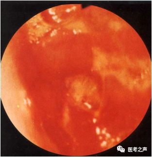 推理记忆，终身不忘：急性胃炎，不过如此！