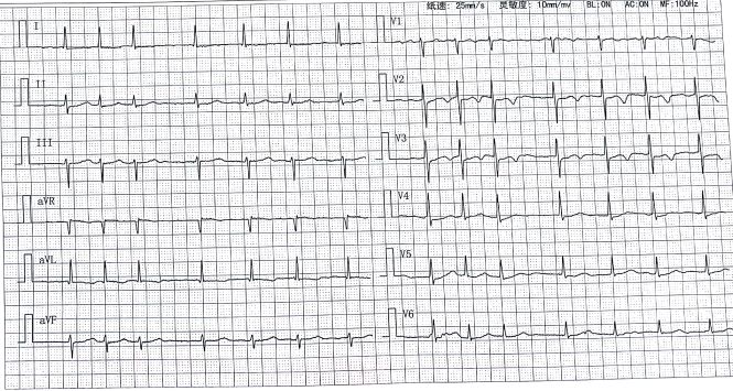 「病例帮」房颤合并冠心病患者抗栓策略之一：当房颤遇上ACS