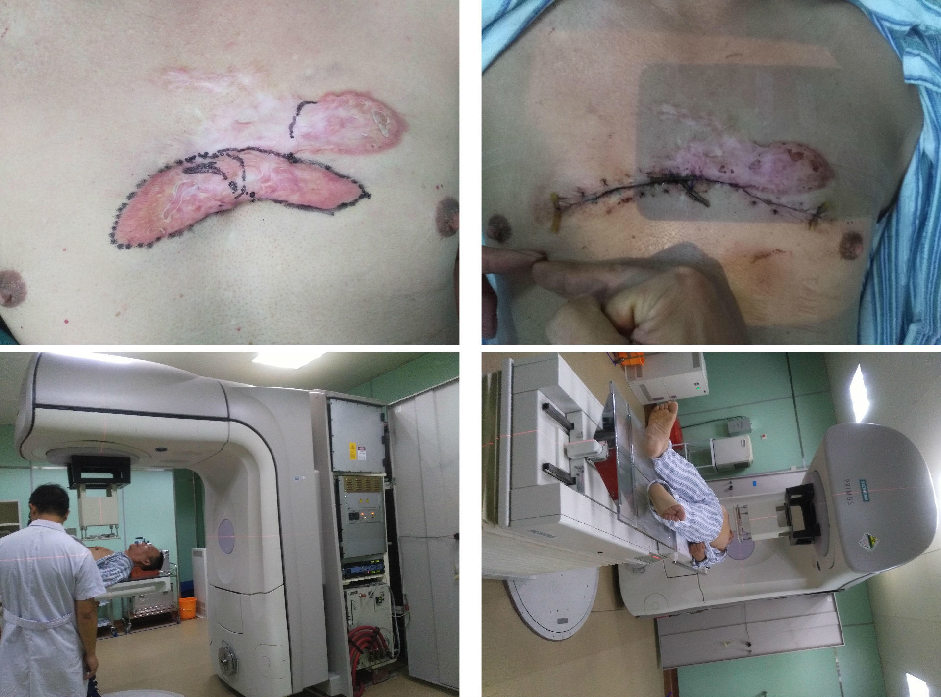 瘢痕的治疗是世界性的难题吗,顽固性伤口疤痕