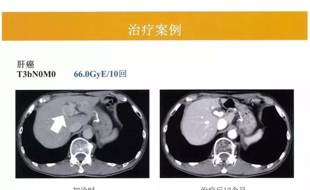 质子放疗中心安全距离,质子放疗介绍费