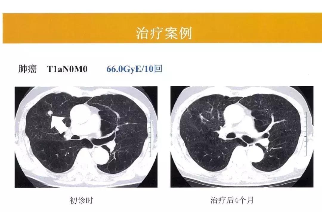质子放疗中心安全距离,质子放疗介绍费