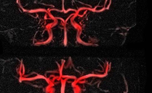 脑中风早期要花多少钱治好呢,脑中风一招救命