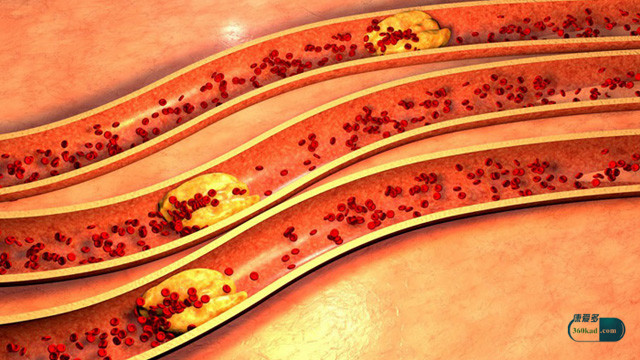 什么生活习惯会导致血管硬化,血管硬化吃什么药能软化血管