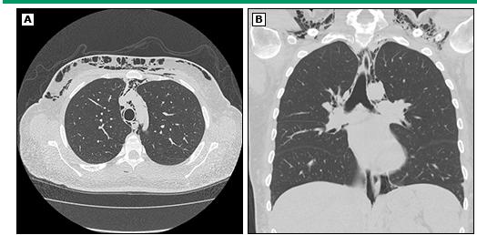 多发性肌炎和皮肌炎的首选药物是,皮肌炎与多发性肌炎的病因介绍