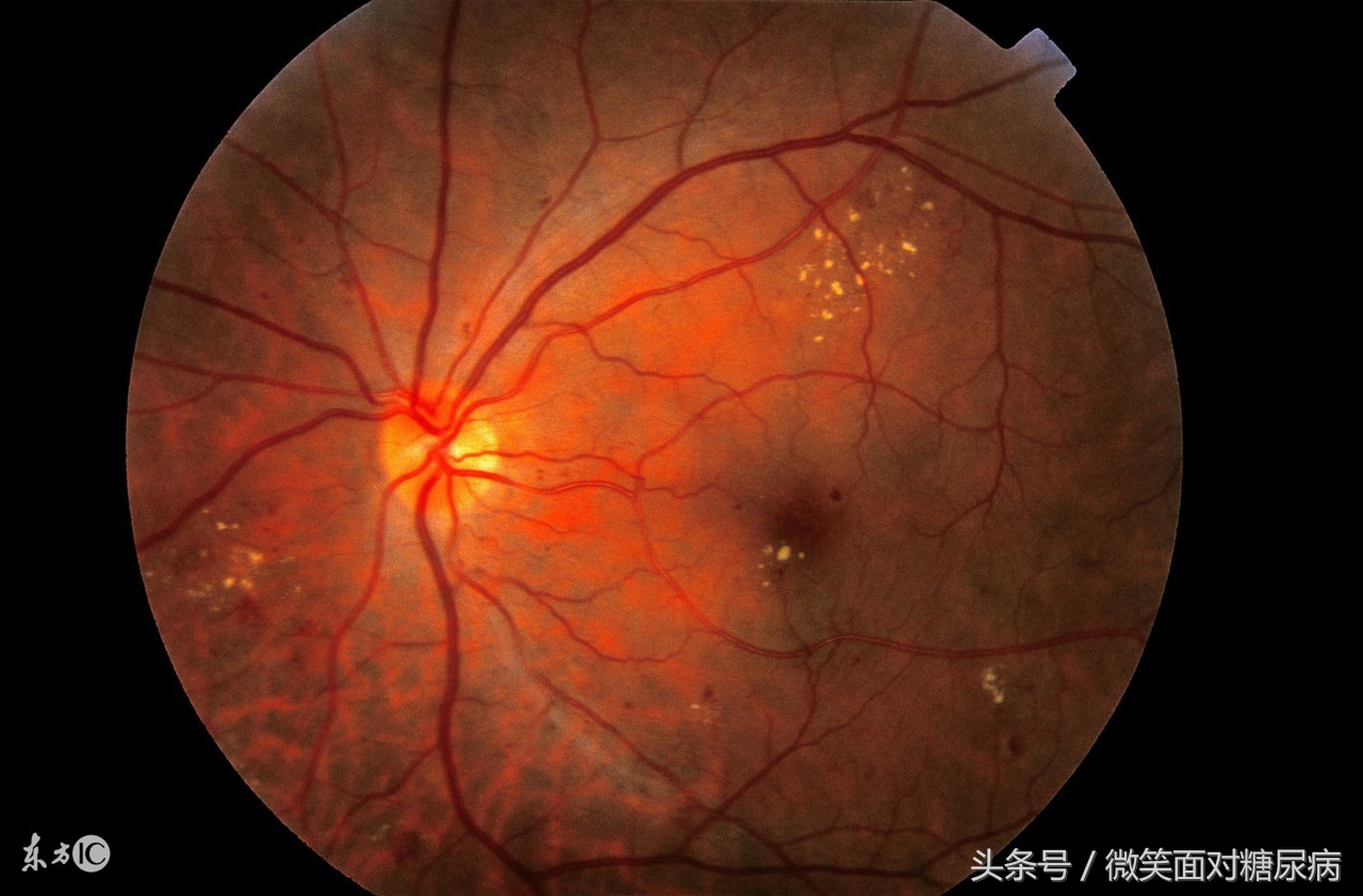 一文解决糖尿病,糖尿病的10种并发症图片