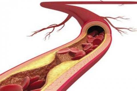 高血脂高胆固醇的危害有哪些,高血脂能吃核桃吗有什么危害
