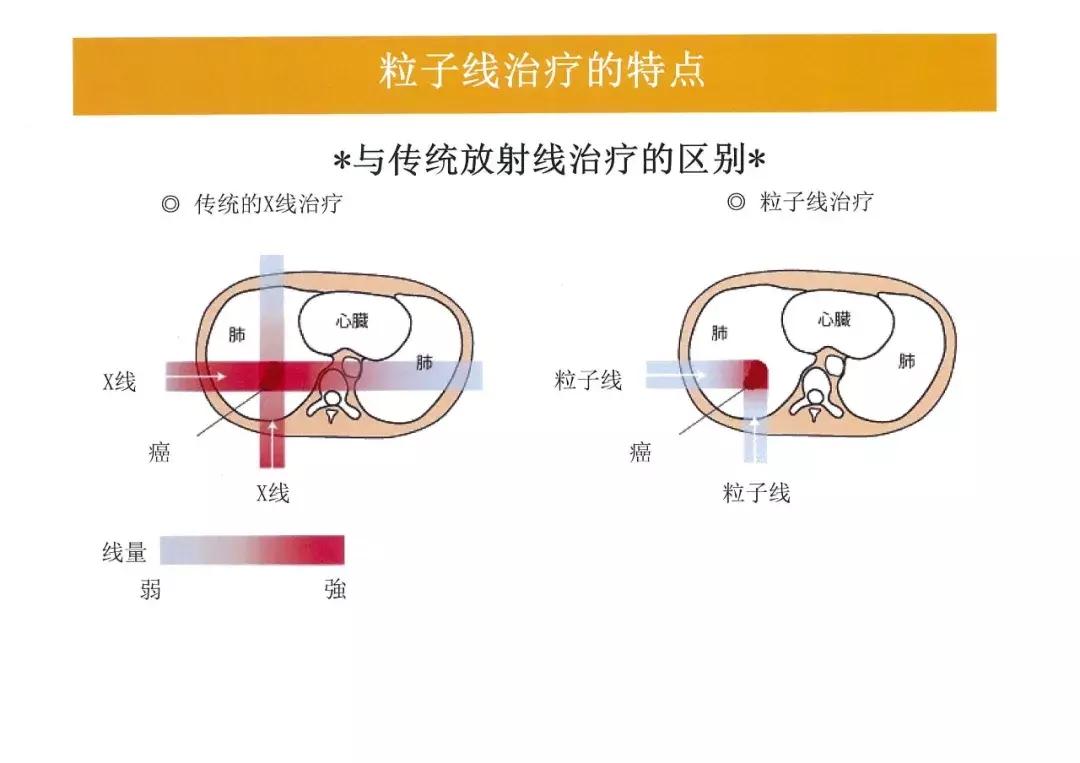 质子放疗中心安全距离,质子放疗介绍费