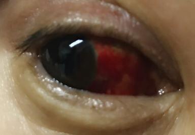 这种“眼红”很吓人