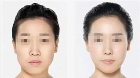 「爱美」双眼之间“一片荒芜”，鼻子一塌毁所有啊！