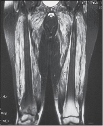 多发性肌炎和皮肌炎的首选药物是,皮肌炎与多发性肌炎的病因介绍