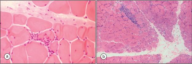 多发性肌炎和皮肌炎的首选药物是,皮肌炎与多发性肌炎的病因介绍