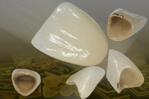 我们该如何去选择合适的烤瓷牙,烤瓷牙多少钱一颗合适