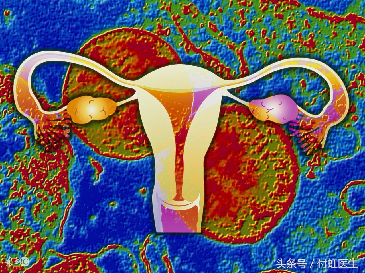 妇科炎症导致的盆腔炎怎么治,湿热型盆腔炎怎么调理