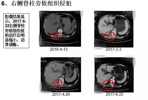 肺腺癌晚期nkt细胞免疫治疗价格,肺癌晚期nk细胞疗法