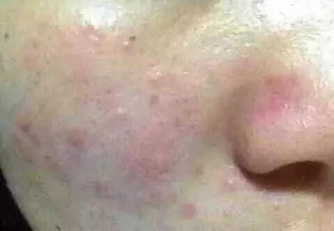 敏感肌冬季护理小常识,敏感肌的春季防敏攻略来咯