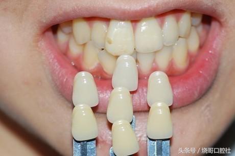 牙齿做牙冠哪种材料好,牙冠材料的种类及优缺点