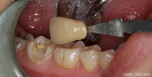 牙齿做牙冠哪种材料好,牙冠材料的种类及优缺点