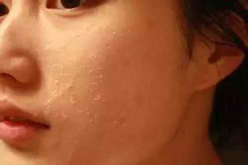 敏感肌冬季护理小常识,敏感肌的春季防敏攻略来咯