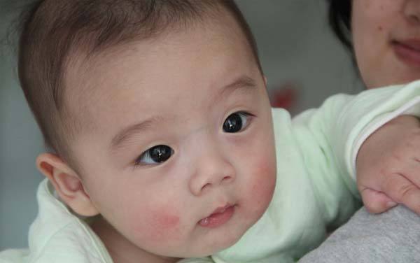 宝宝皮肤冬天皲裂小妙招,宝宝皮肤皲裂图片