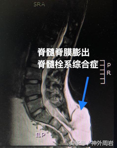 婴幼儿腰骶部有包块，这是神经疾病，会造成致命性的肾损害