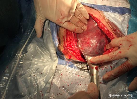 产科疑难病例超声会诊,孕期前置胎盘子宫肌瘤怎么处置