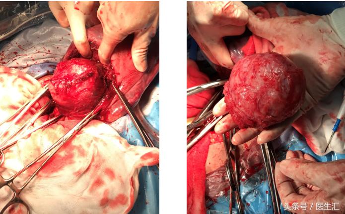 产科疑难病例超声会诊,孕期前置胎盘子宫肌瘤怎么处置