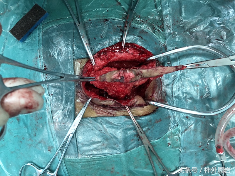 婴幼儿腰骶部有包块，这是神经疾病，会造成致命性的肾损害