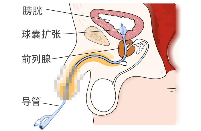 尿管怎么卡住,尿管怎么卡住不让尿液流出