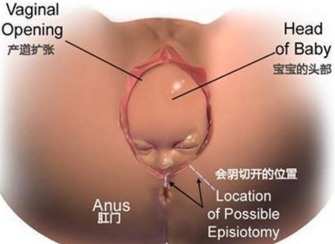 为什么女人顺产比剖腹产更容易,为什么现在顺产要侧切