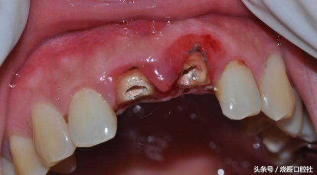门牙磕掉一丢丢可以长回去吗,2岁宝宝门牙磕掉了一角怎么补
