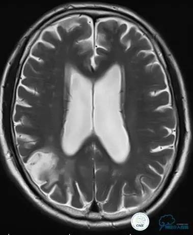 颅内动脉狭窄介入治疗研究,颅内血管cta副作用